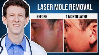 Laser Mole Removal  Live Procedure [upl. by Maccarthy]