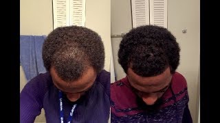 Rogaine Minoxidil Journey  Week 10 [upl. by Nickles]