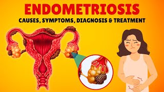 What is Endometriosis Causes Signs and Symptoms Diagnosis amp Treatment [upl. by Barhos449]