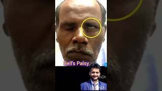 Bells palsy shorts [upl. by Choo]