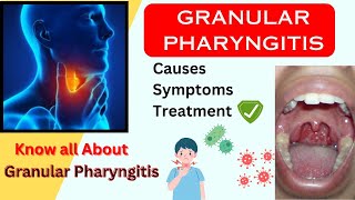 Granular Pharyngitis Causes Symptoms amp Treatment  sore throat treatment health [upl. by Ydderf433]