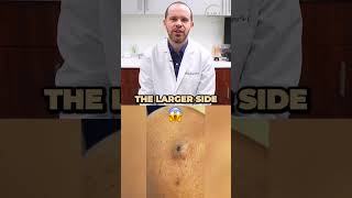 Reacting to a MASSIVE Epidermal Inclusion Cyst [upl. by Eboj]