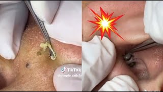 Ultimate Satisfying Banish Acne Blackheads and Whiteheads 😍 [upl. by Rodger886]