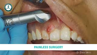 Painless Laser Surgery of Oral Epulis [upl. by Eivi750]