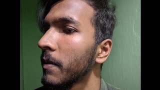 permanent results of minoxidil on beard  man matters beardmax  used for 6 months 🌿 [upl. by Earas]