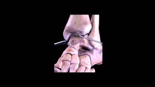 Artroscopia de tobillo pinzamiento Ankle arthroscopy impingement [upl. by Hamforrd]