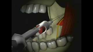 Mandibular Anesthesia  Inferior Alveolar Nerve Block [upl. by Eiltan623]