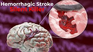 Hemorrhagic Stroke  causes symptoms diagnosis treatment pathology [upl. by Saberhagen]