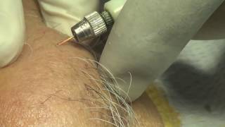 Permanent painless hair removal of chin electrolysis [upl. by Milly646]