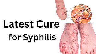 Latest treatment of syphilis How to cure any stage of syphilis [upl. by Mattox831]