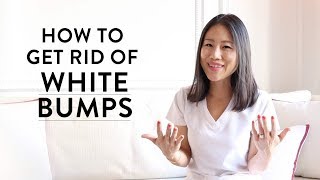 How to Get Rid of the White Bumps on Your Face  Peach amp Lily [upl. by Yenots7]