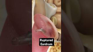 How does an eardrum rupture 3D Animation [upl. by Dela]