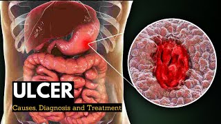 Ulcer Causes Signs and Symptoms Diagnosis and Treatment [upl. by Ititrefen427]