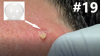 BLACKHEAD EXTRACTION on Happy 19 [upl. by Anavahs]