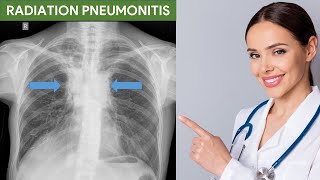 Radiation Pneumonitis [upl. by Yreva]