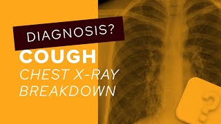 Chest XRay breakdown a guide to bronchiectasis on imaging [upl. by Yeldua]