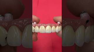 Cementing Crowns dentist zirconia dentalrestoration fullmouthdentalimplants dental shorts [upl. by Aihk]