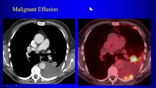 3b Lung Cancer P2 [upl. by Sukramal]