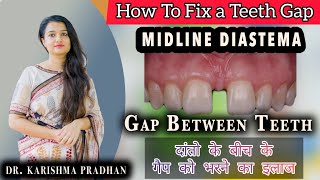 Gaps Between Teeth and Solutions  दाँतो के बीच गेप भरने का इलाज  Midline Diastema Closer Treatment [upl. by Mariko]