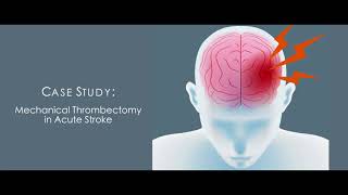 The Specialists  Transforming Healthcare  Case Study IV Thrombolysis in Acute Stroke [upl. by Yand]