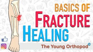 Fracture Healing  ANIMATION  BASICS  The Young Orthopod [upl. by Eerased944]