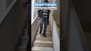 Femur Fracture  Climbing Stairs after recovery pradeepkanth femur [upl. by Cummine]