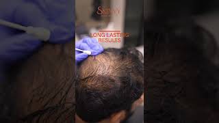 PRP Treatment at Skinvy Clinic  KPHB Hyderabad [upl. by Arondel]