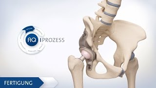 Hüft TEP  Individuelles künstliches Hüftgelenk Ärztefassung deutsch  3D Animation Medizin [upl. by Adne]