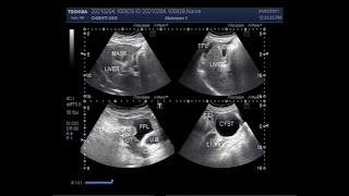 Thickwalled Gallbladder Hepatic Mass with Hepatic parenchymal disease and ascites [upl. by Mauldon]