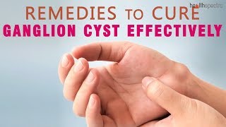 10 Remedies to Cure Ganglion Cyst Effectively [upl. by Aicire]