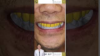 Bringing Back Your Smile Best dentist smiledesigndentistry smiledesigndental smilemakeover [upl. by Arah]