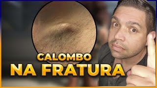 CALOMBO NA FRATURA É NORMAL [upl. by Dubois]