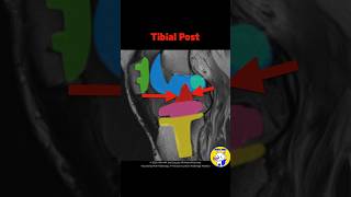 Fig 5D04 MRI Findings of Posterior Stabilized TKA Part 2 [upl. by Rosanna]