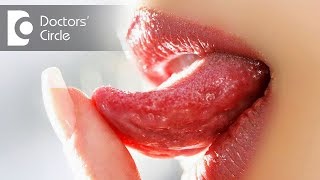 Common causes of ulcers on tongue in your 30s  Dr Aniruddha KB [upl. by Ellery949]