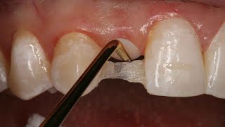 Direct Resin Bonded Bridge  Dental Online Training [upl. by Oznerol329]