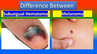 Subungual Hematoma Vs Melanoma [upl. by Gussy]