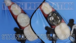 Tooth Preparation for Stainless Steel Crown  stainless steel crown procedure steps  ssc [upl. by Skill]