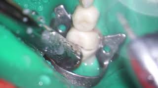 Removal of posterior pediatric zirconia crown for endodontic treatment [upl. by Rosalind264]