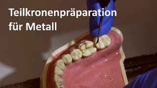 Präparation der Metallteilkrone Teilkronenpräparationen für Metall 4K [upl. by Oakman]