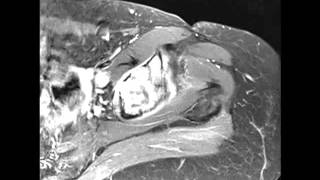 Chondrosarcoma of the Acetabulum [upl. by Johansen47]