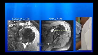 Ultrasound of SubcoracoidSubdeltoid Bursitis amp Partial vs SmallFull Thickness Supraspinatus Tear [upl. by Enajiram]