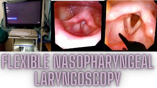 Flexible Nasopharyngeal LaryngoscopyNPL [upl. by Ahcim]