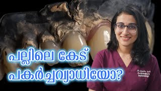 പല്ലിലെ കേട് പകർച്ചവ്യാധിയോ തീർച്ചയായും കാണുക [upl. by Azeria]