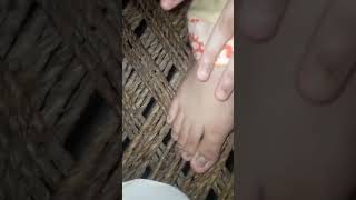 Trichophyton rubrum fungus nailinfection dermatology medical dermatology diagnosis foot [upl. by Themis]