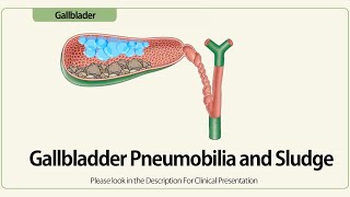 Linear EUS Gallbladder Pneumobilia and Sludge [upl. by Karlow]