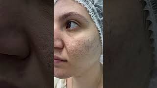 PRPMicroneedling treatment viral skincare viralvideo shorts [upl. by Lessirg]