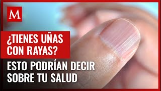 Las rayas en las uñas podrían ser un indicativo de algunas condiciones médicas te contamos cuáles [upl. by Aiekam]