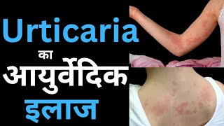 What is Urticaria Causes Home Remedies amp Ayurvedic Treatment [upl. by Gaw187]