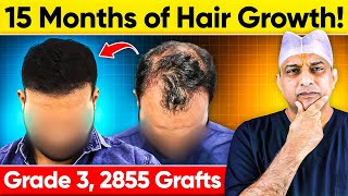 Hair Transplant Results in Agra India 2855 Grafts Norwood Grade 3  Hair Transplant Cost [upl. by Conyers254]