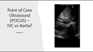 Point of Care Ultrasound POCUS  How to Differentiate IVC vs Aorta [upl. by Katerine]